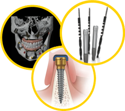 implantes